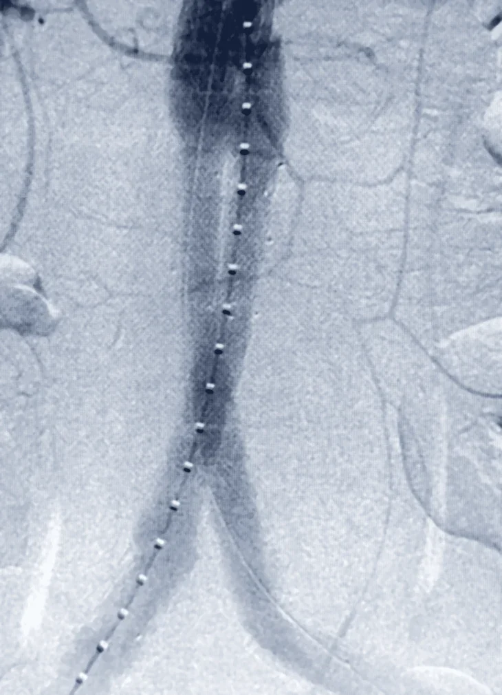 Angiografia real feita pelo Dr. Alexandre: a aorta em cinza, com a fileira de pontos brancos da endoprótese posicionada por dentro dela até a bifurcação das artérias das pernas.